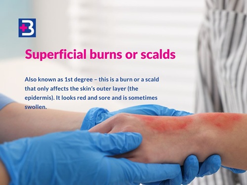How to recognise and treat a burn How to recognise and treat a burn